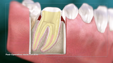 Home Care: Root Canal Therapy