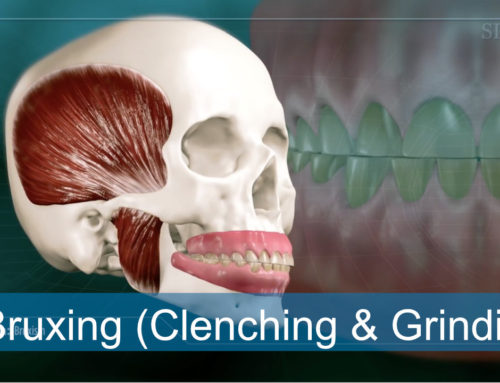 Bruxism (Clenching and Grinding)