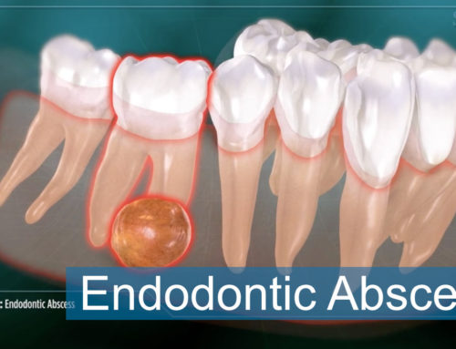 Endodontic Abscess